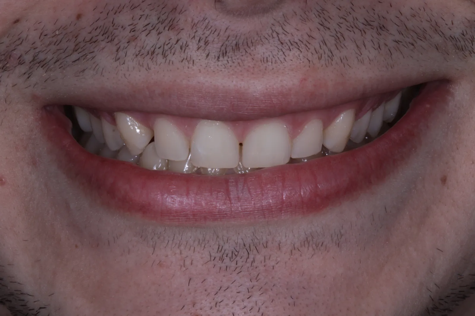 Sorriso do caso 1 antes do tratamento