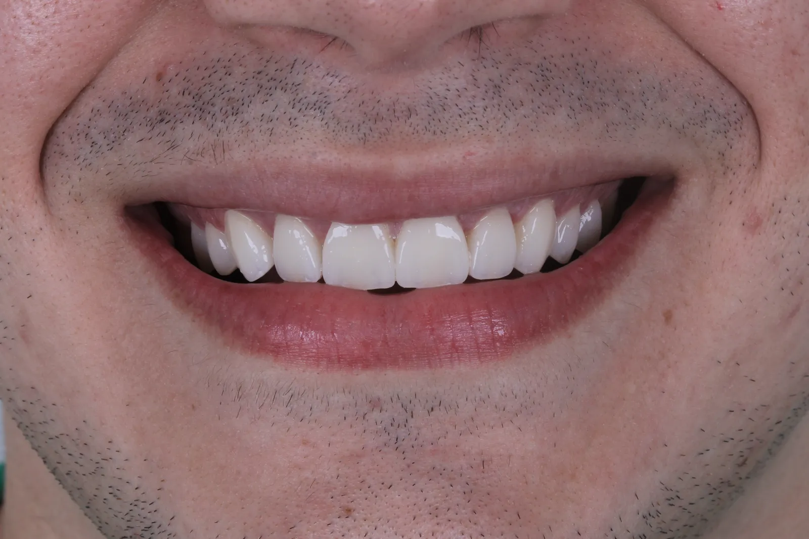 Sorriso do caso 1 depois do tratamento na Ahid