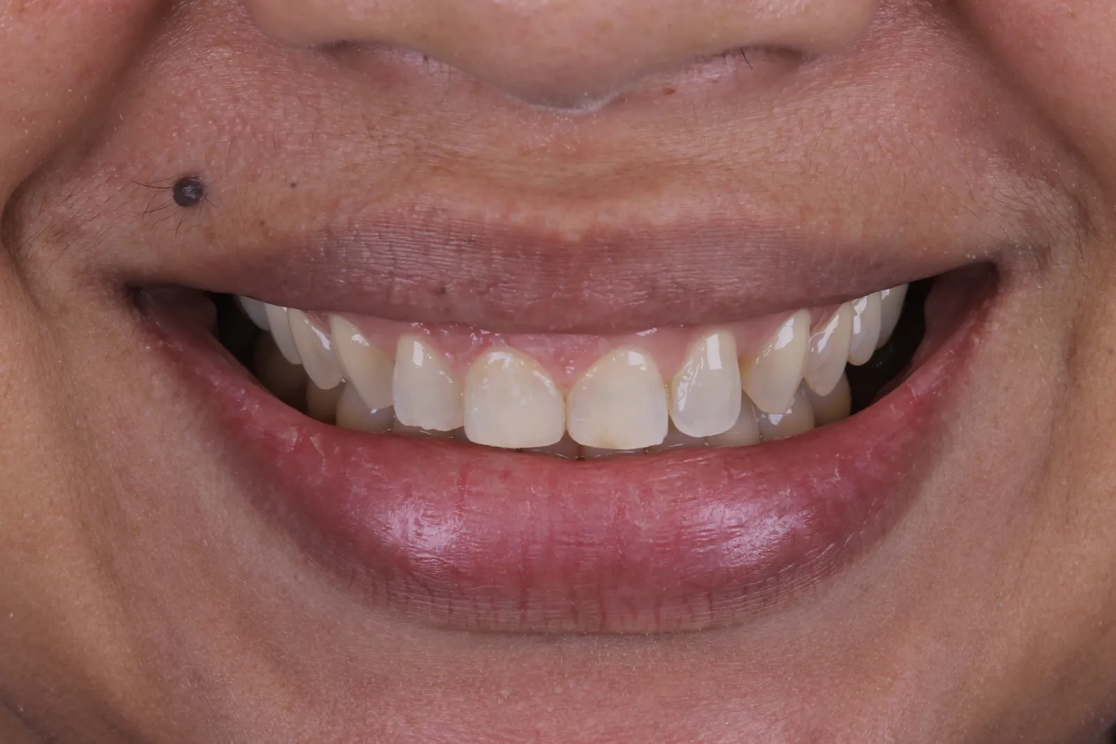 Sorriso do caso 2 antes do tratamento
