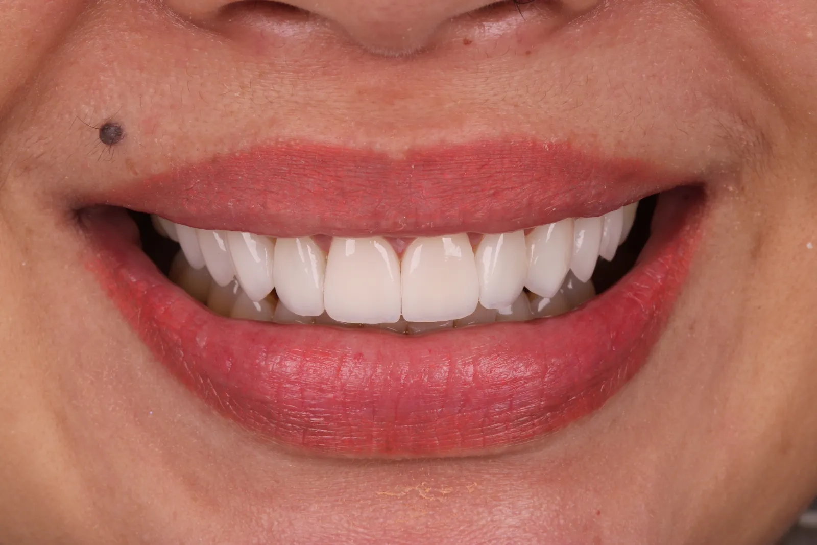 Sorriso do caso 2 depois do tratamento na Ahid